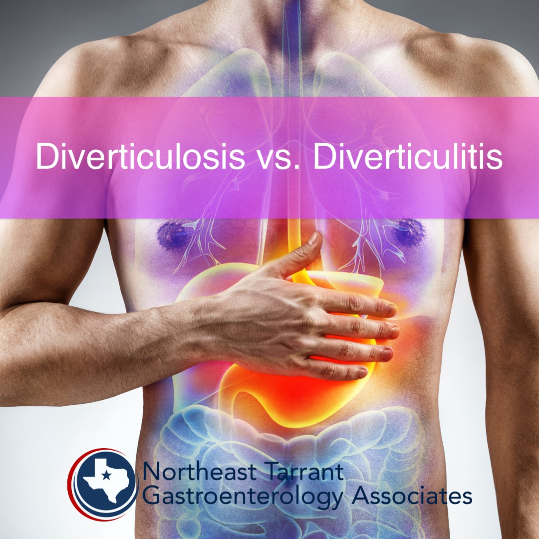 Diverticulosis vs. Diverticulitis