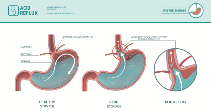 Acid Reflux GERD GI Doctors Fort Worth