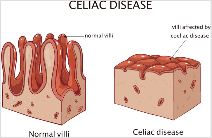 Celiac Disease