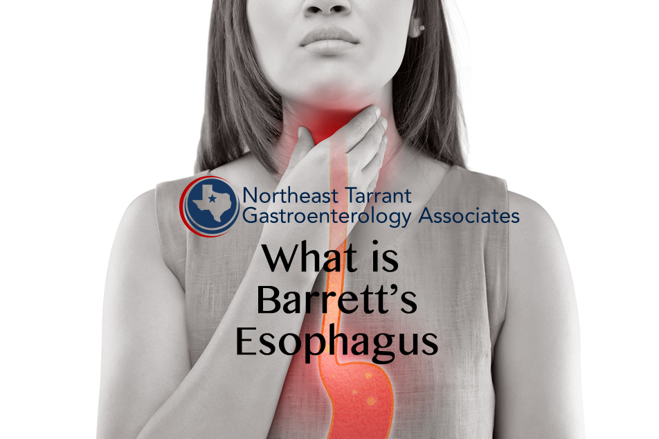 What Is Barrett's Esophagus